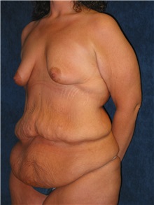 Tummy Tuck Before Photo by Scott Miller, MD; La Jolla, CA - Case 8225