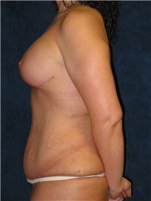 Tummy Tuck After Photo by Scott Miller, MD; La Jolla, CA - Case 8225