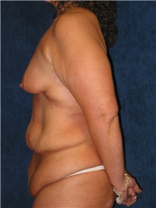 Tummy Tuck Before Photo by Scott Miller, MD; La Jolla, CA - Case 8225