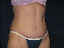 Tummy Tuck After Photo by Scott Miller, MD; La Jolla, CA - Case 8226