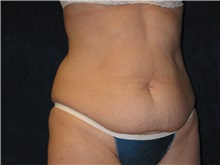 Tummy Tuck Before Photo by Scott Miller, MD; La Jolla, CA - Case 8226