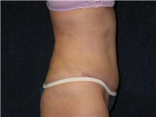 Tummy Tuck After Photo by Scott Miller, MD; La Jolla, CA - Case 8226