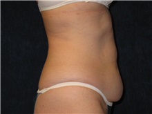 Tummy Tuck Before Photo by Scott Miller, MD; La Jolla, CA - Case 8226