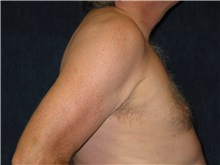 Male Breast Reduction After Photo by Scott Miller, MD; La Jolla, CA - Case 8227