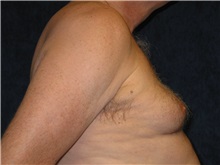 Male Breast Reduction Before Photo by Scott Miller, MD; La Jolla, CA - Case 8227