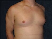 Male Breast Reduction Before Photo by Scott Miller, MD; La Jolla, CA - Case 8228