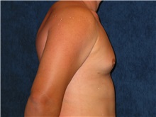 Male Breast Reduction After Photo by Scott Miller, MD; La Jolla, CA - Case 8228