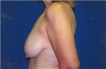 Breast Lift Before Photo by Scott Miller, MD; La Jolla, CA - Case 8230