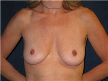 Breast Lift Before Photo by Scott Miller, MD; La Jolla, CA - Case 8232