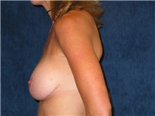 Breast Lift After Photo by Scott Miller, MD; La Jolla, CA - Case 8232