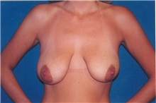 Breast Lift Before Photo by Scott Miller, MD; La Jolla, CA - Case 8233