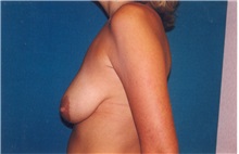 Breast Lift Before Photo by Scott Miller, MD; La Jolla, CA - Case 8233