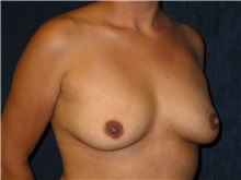 Breast Augmentation Before Photo by Scott Miller, MD; La Jolla, CA - Case 8235