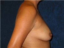 Breast Augmentation Before Photo by Scott Miller, MD; La Jolla, CA - Case 8235