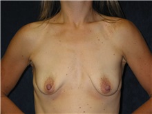 Breast Augmentation Before Photo by Scott Miller, MD; La Jolla, CA - Case 8236