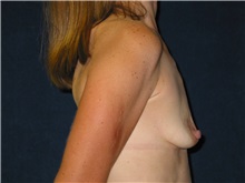 Breast Augmentation Before Photo by Scott Miller, MD; La Jolla, CA - Case 8236