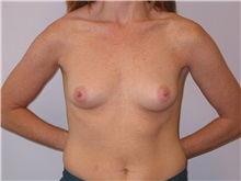 Breast Augmentation Before Photo by Scott Miller, MD; La Jolla, CA - Case 8237