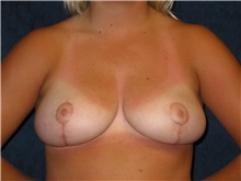 Breast Reduction After Photo by Scott Miller, MD; La Jolla, CA - Case 8238