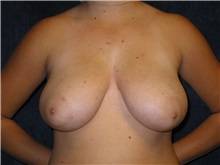 Breast Reduction Before Photo by Scott Miller, MD; La Jolla, CA - Case 8238