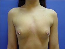 Breast Augmentation Before Photo by Jennifer Walden, MD; Austin, TX - Case 7331