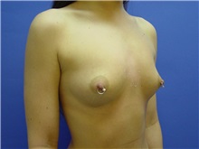 Breast Augmentation Before Photo by Jennifer Walden, MD; Austin, TX - Case 7331