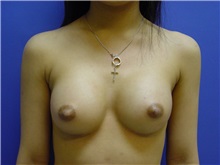 Breast Augmentation After Photo by Jennifer Walden, MD; Austin, TX - Case 7332