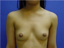 Breast Augmentation Before Photo by Jennifer Walden, MD; Austin, TX - Case 7332