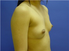 Breast Augmentation Before Photo by Jennifer Walden, MD; Austin, TX - Case 7332