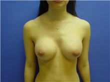 Breast Augmentation After Photo by Jennifer Walden, MD; Austin, TX - Case 7333