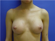 Breast Augmentation After Photo by Jennifer Walden, MD; Austin, TX - Case 7334
