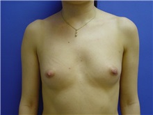 Breast Augmentation Before Photo by Jennifer Walden, MD; Austin, TX - Case 7334