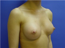 Breast Augmentation After Photo by Jennifer Walden, MD; Austin, TX - Case 7334