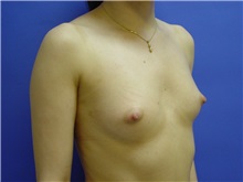 Breast Augmentation Before Photo by Jennifer Walden, MD; Austin, TX - Case 7334