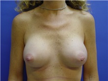 Breast Augmentation After Photo by Jennifer Walden, MD; Austin, TX - Case 7335