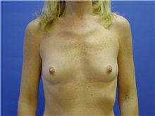 Breast Augmentation Before Photo by Jennifer Walden, MD; Austin, TX - Case 7335