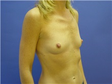 Breast Augmentation Before Photo by Jennifer Walden, MD; Austin, TX - Case 7335