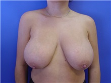 Breast Reduction Before Photo by Jennifer Walden, MD; Austin, TX - Case 7336