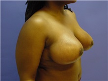 Breast Reduction After Photo by Jennifer Walden, MD; Austin, TX - Case 7337