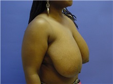 Breast Reduction Before Photo by Jennifer Walden, MD; Austin, TX - Case 7337