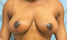 Breast Reduction After Photo by Julia Spears, MD, FACS; Marlton, NJ - Case 45640