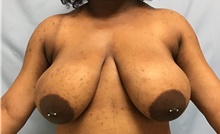 Breast Reduction Before Photo by Julia Spears, MD, FACS; Marlton, NJ - Case 45640