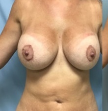 Breast Lift After Photo by Julia Spears, MD, FACS; Marlton, NJ - Case 46522