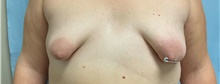 Breast Augmentation Before Photo by Julia Spears, MD, FACS; Marlton, NJ - Case 46526