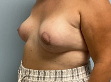 Breast Augmentation After Photo by Julia Spears, MD, FACS; Marlton, NJ - Case 46526