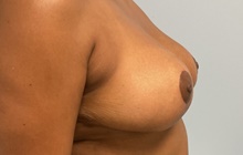 Breast Reduction After Photo by Julia Spears, MD, FACS; Marlton, NJ - Case 46545