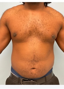 Liposuction After Photo by Julia Spears, MD, FACS; Marlton, NJ - Case 46546