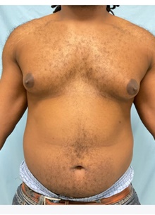 Liposuction Before Photo by Julia Spears, MD, FACS; Marlton, NJ - Case 46546