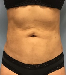 Liposuction After Photo by Julia Spears, MD, FACS; Marlton, NJ - Case 46549