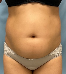 Liposuction Before Photo by Julia Spears, MD, FACS; Marlton, NJ - Case 46549