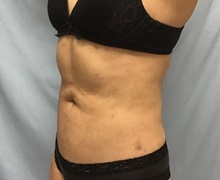 Liposuction After Photo by Julia Spears, MD, FACS; Marlton, NJ - Case 46549